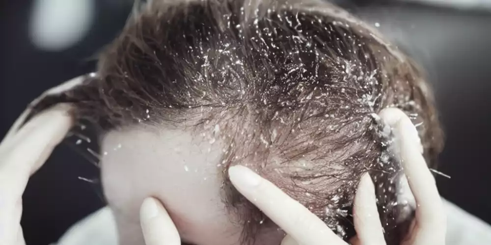 how-to-get-rid-of-dandruff